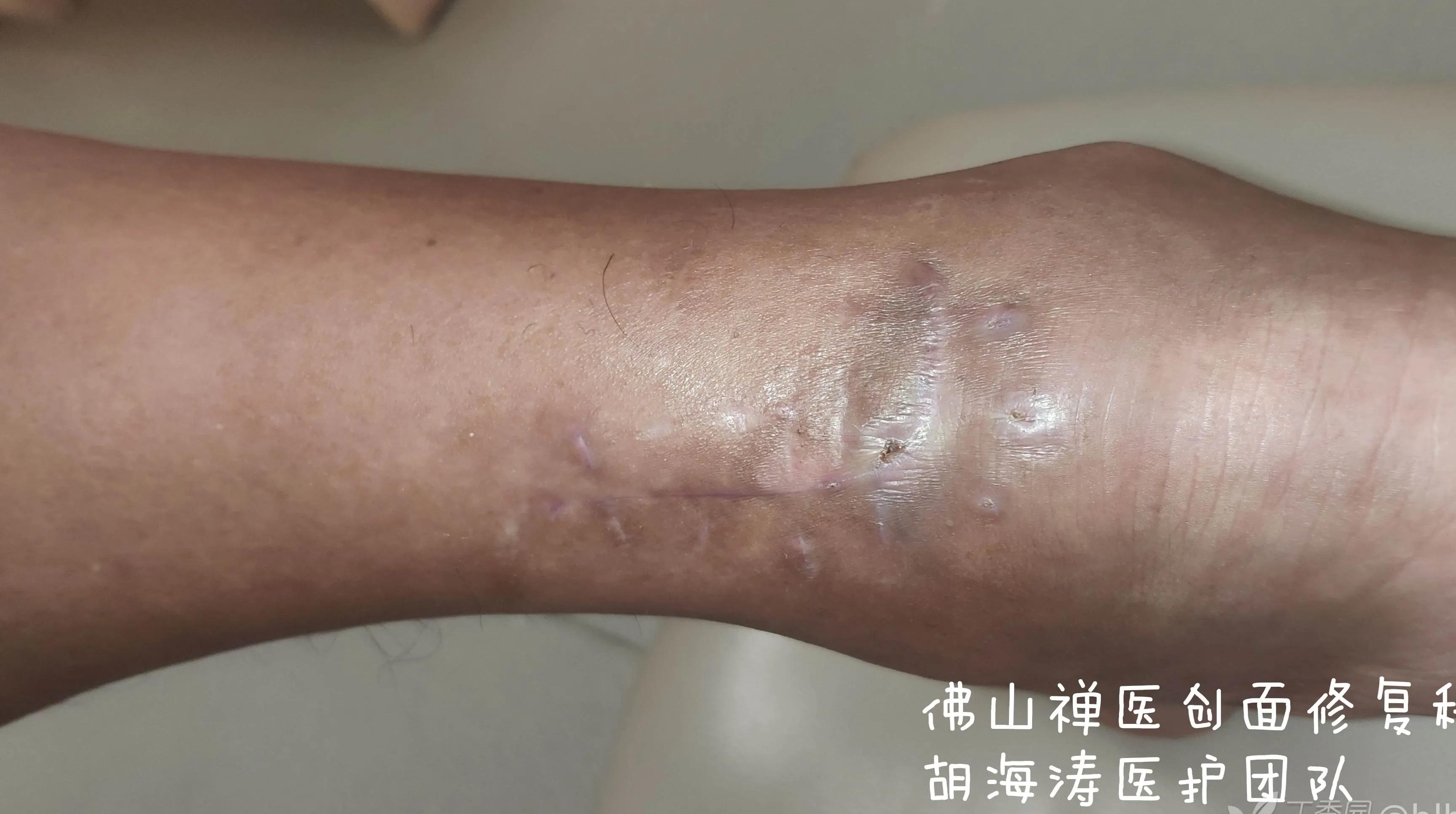 农民工受伤不去治疗,农民工受伤没去医院自己缝合伤口