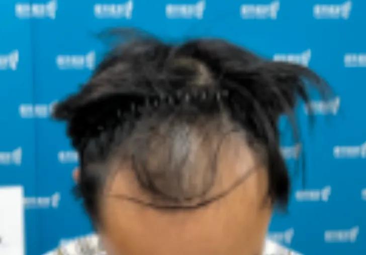 花费四万元植发一年后效果仍不明,男生大面积植发八个月真实效果