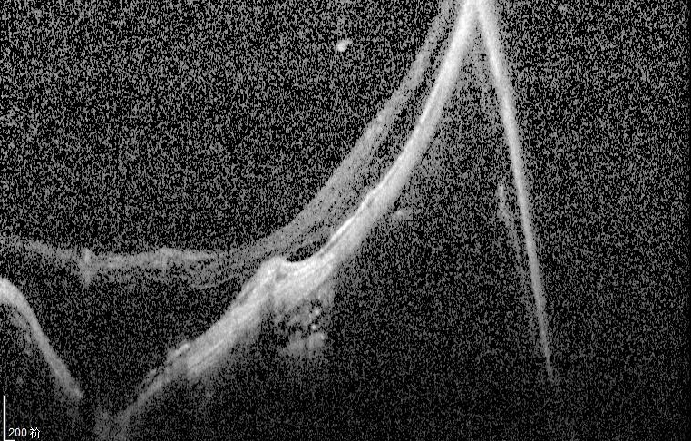 这样“破烂”的超高度近视眼底，还有手术价值吗？