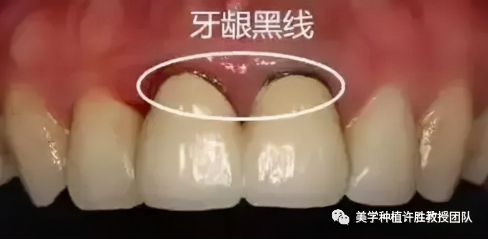 烤瓷牙与全瓷牙的价格,烤瓷牙和全瓷牙的价格相差多少