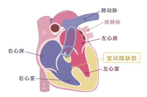 心脏室间隔缺损不治疗行吗,心脏有个洞要补吗