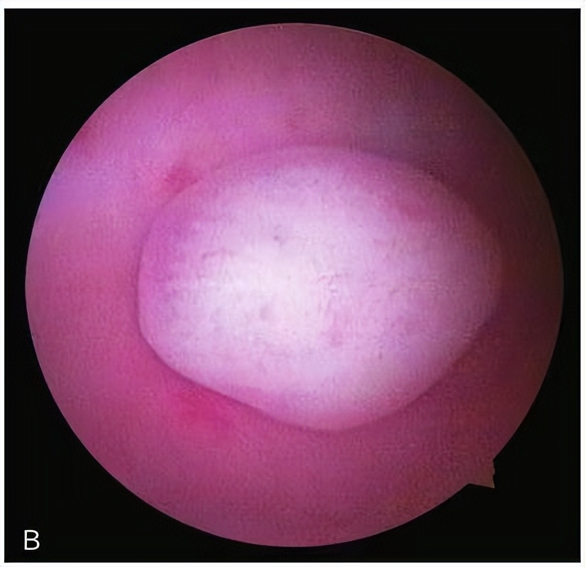 妇科医生5分钟小科普,门诊宫腔镜科普文章