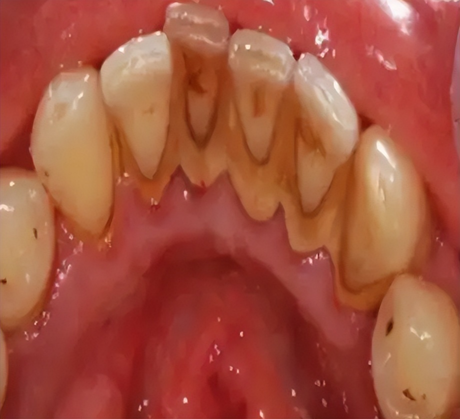 去牙渍牙黄的牙膏测评,能去牙结石的牙粉牙膏推荐