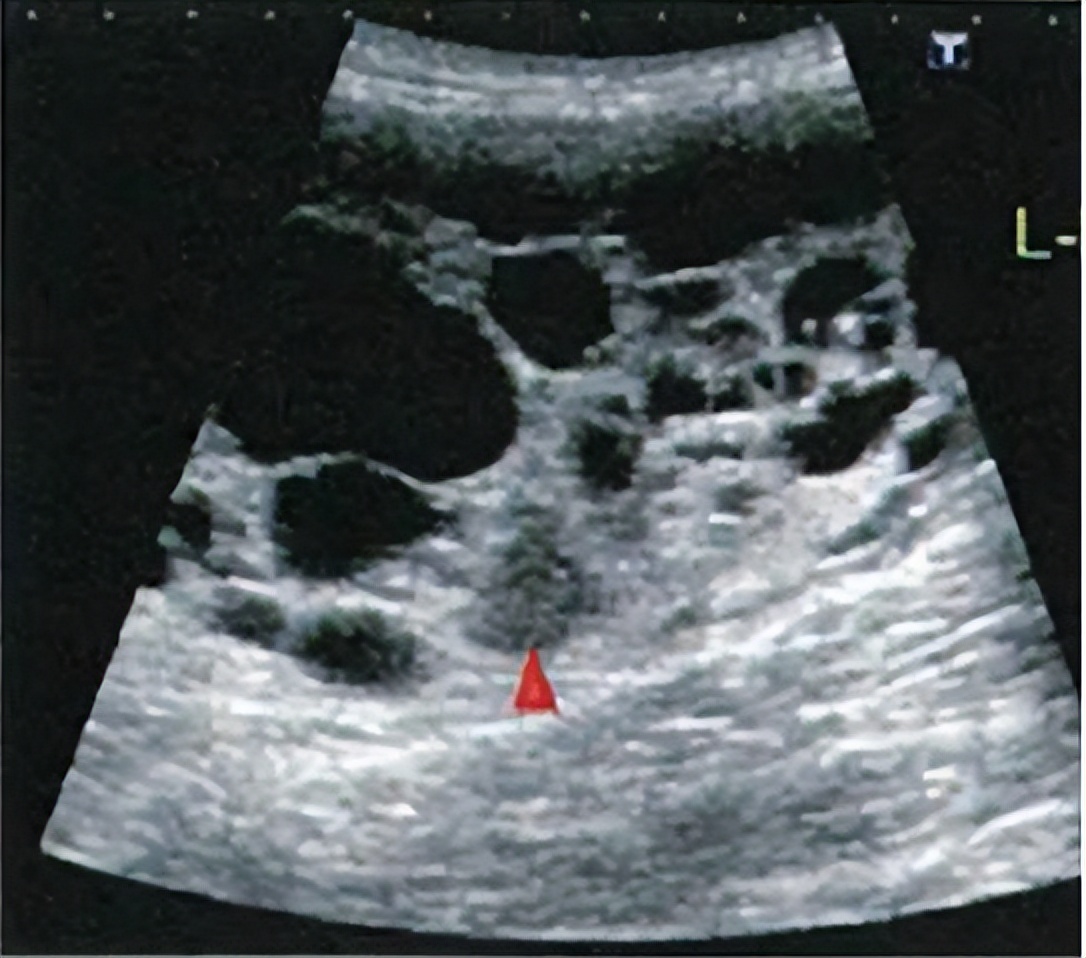 一家接连患尿毒症，是怎么回事？了解最常见的遗传性肾病-多囊肾