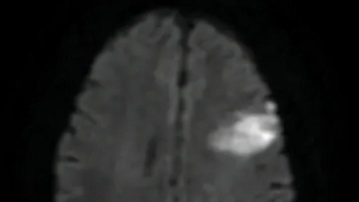 高血压引起脑出血最佳抢救时间,家里老人有点脑出血一般怎么治