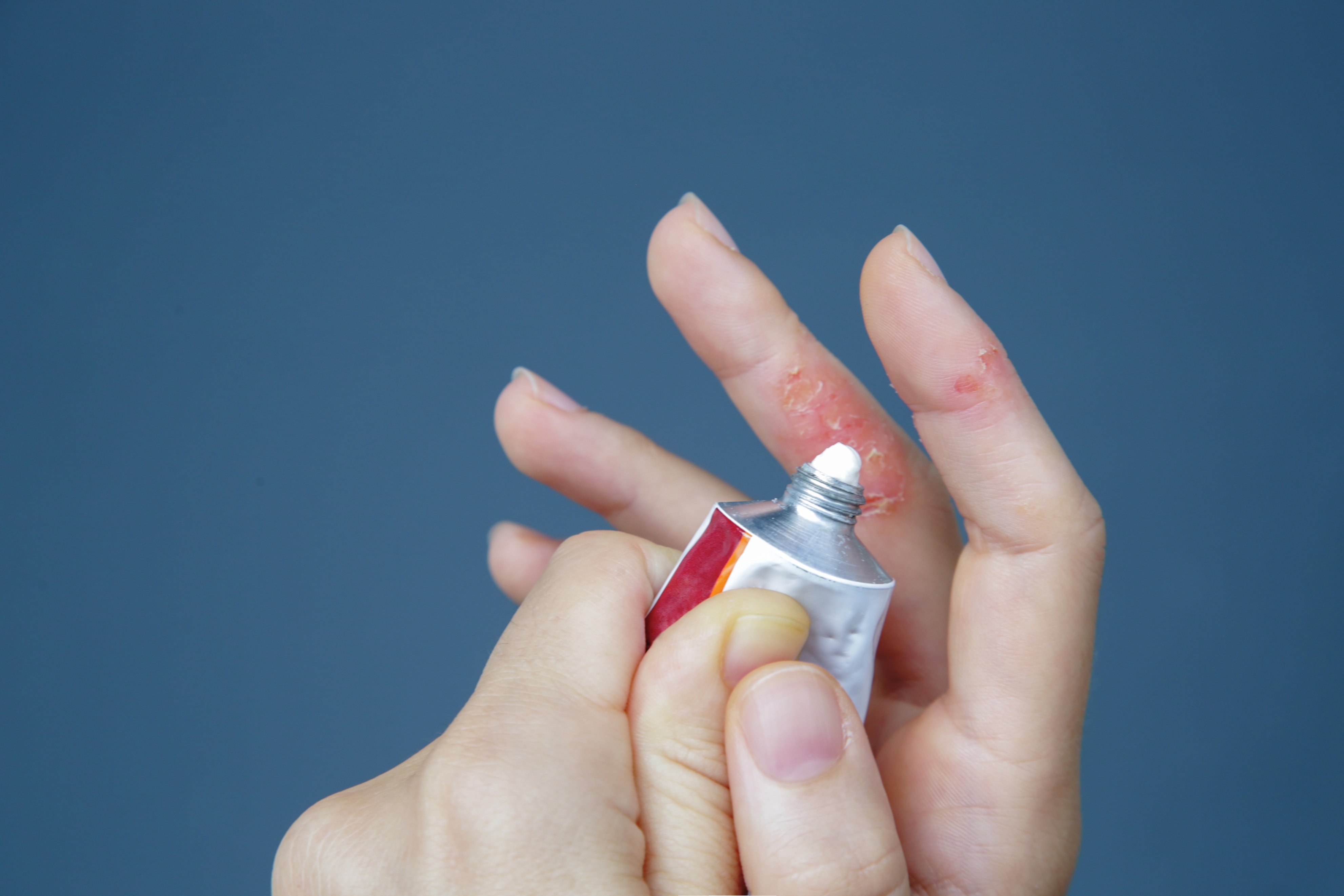 银屑病新药膏上市,2023年银屑病即将上市的新药