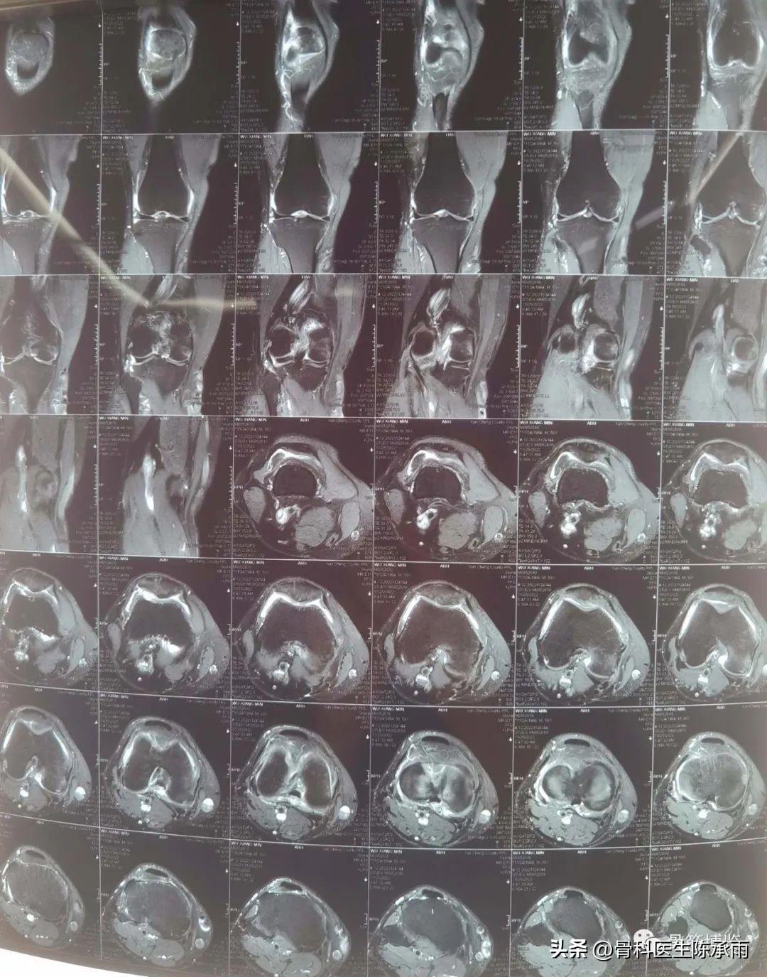 盘状半月板撕裂一级,半月板层裂愈合概率