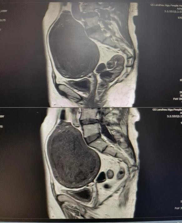 微创小切口解决患者大难题,兰州兰大二院妇科手术
