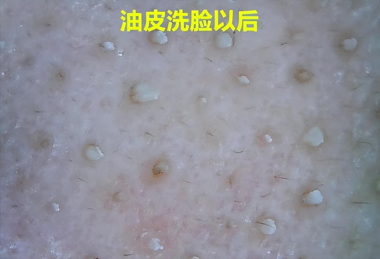 鼻子上有黑点怎么抠掉,鼻子边缘的小白点怎么去除