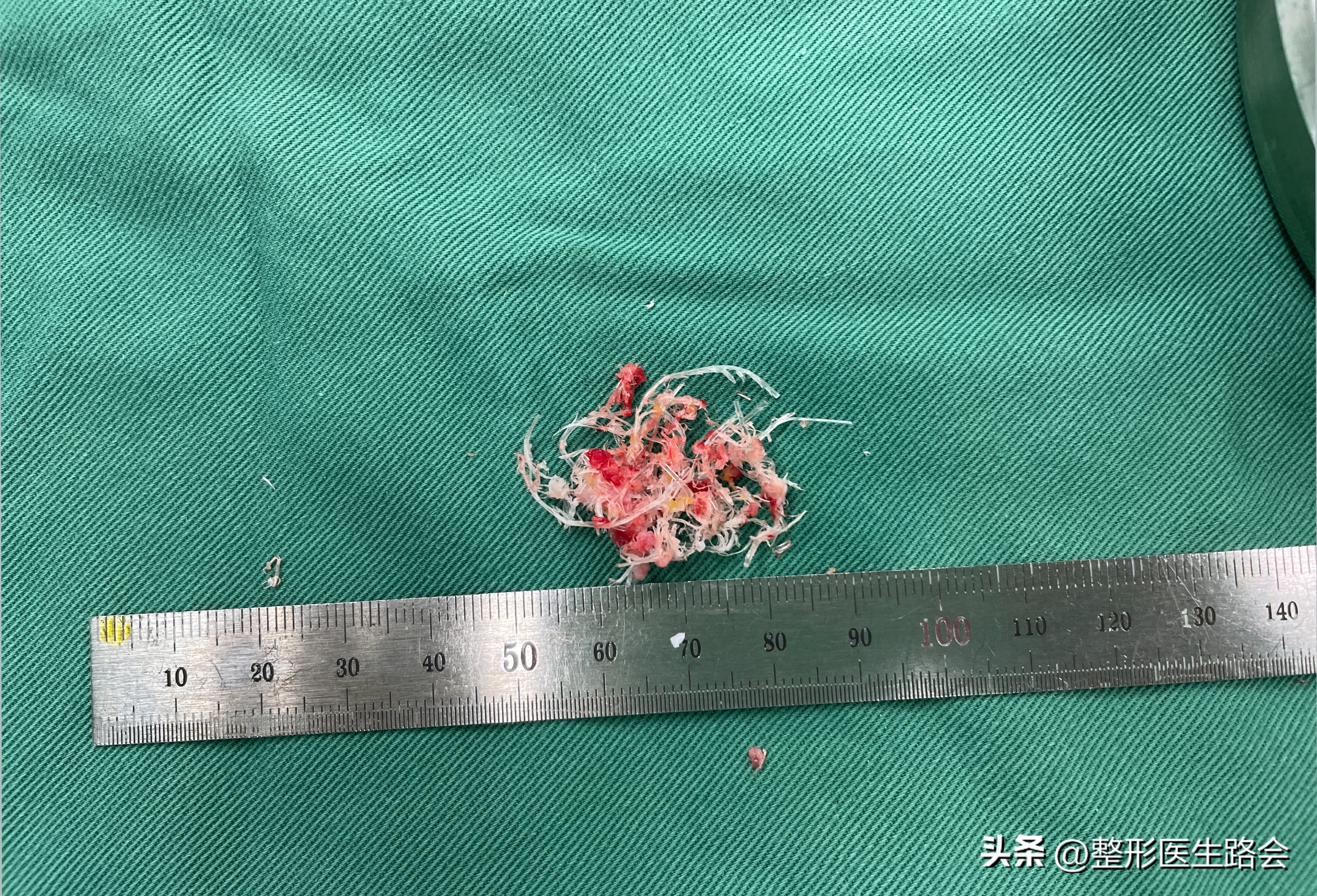 线雕鼻修复成超肋隆鼻,线雕隆鼻能解决鼻基底凹陷吗