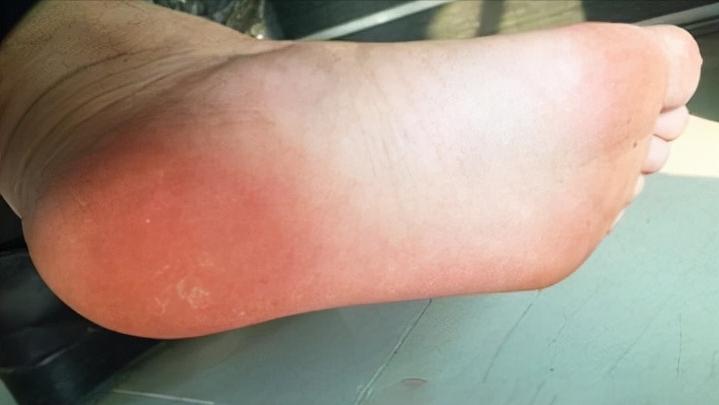 脚底板爱进风什么原因,脚底板走路磨起茧子怎么去