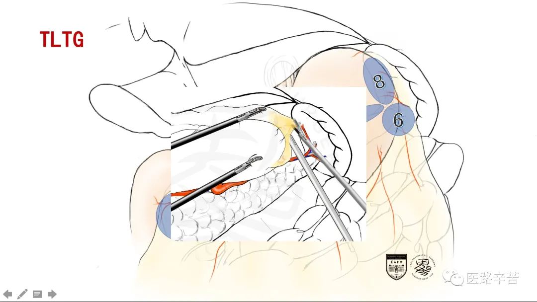 全腹腔镜胃癌根治术，学习大咖怎么清扫淋巴结