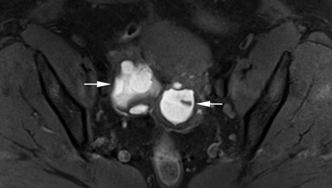 MRI如何评估子宫内膜异位症？这10个病例会帮助您