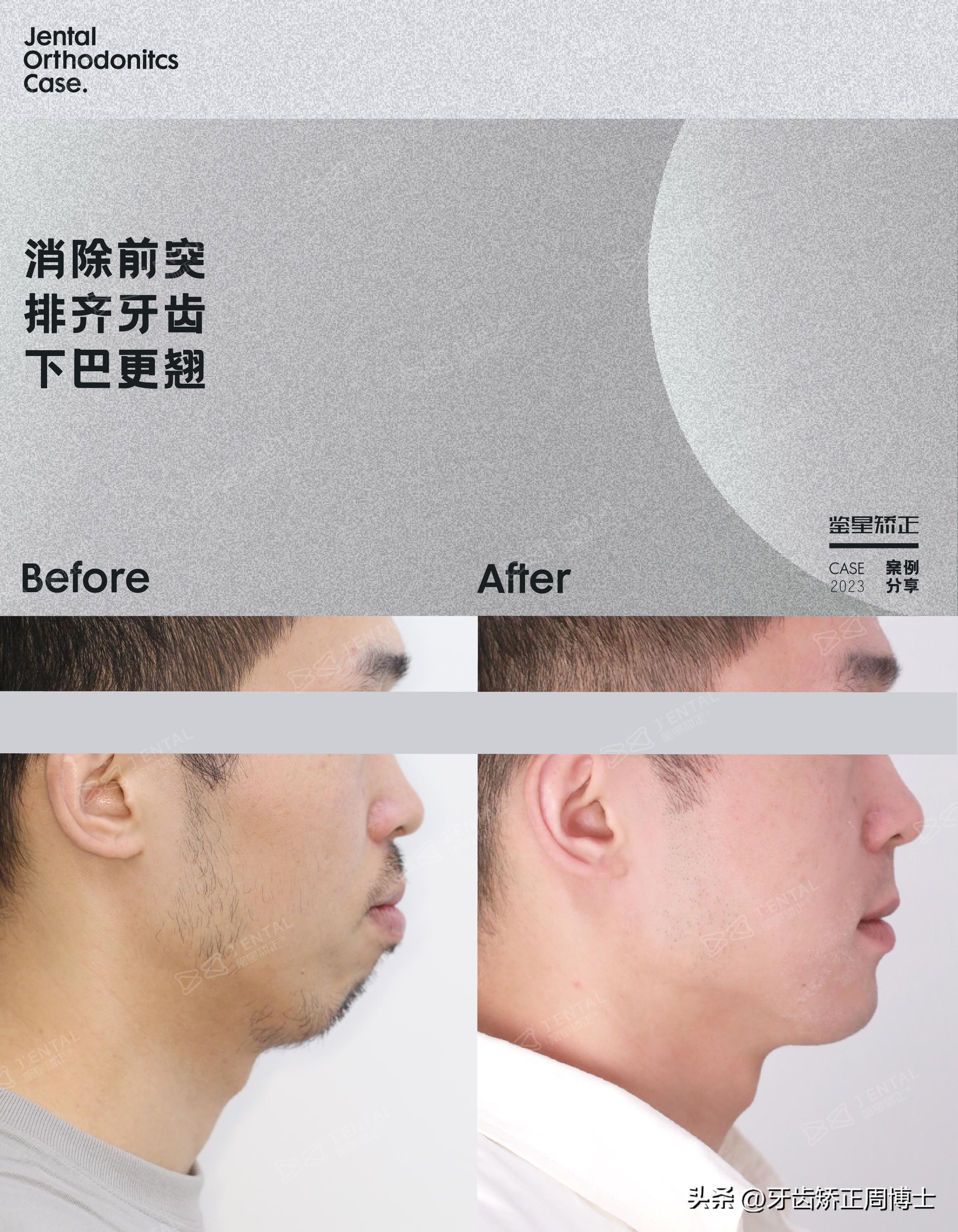 智齿正畸替代第二磨牙危害,智齿矫正代替第二磨牙3d图