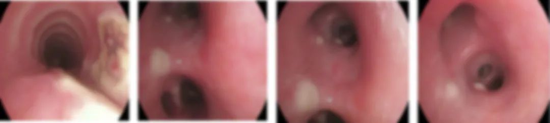 肺部长蘑菇是什么病,肺部有蘑菇结节