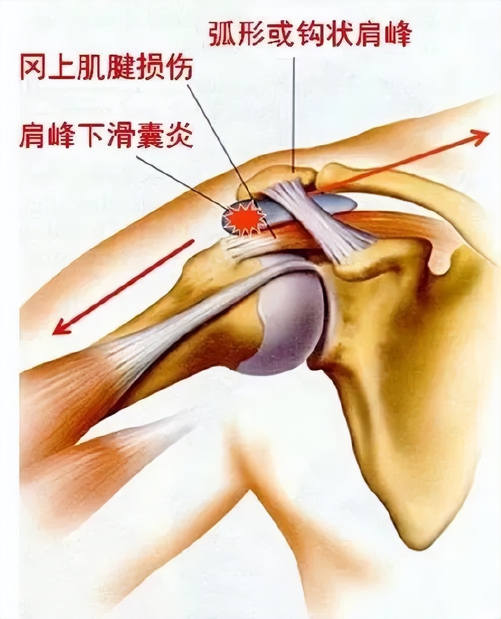 肌效贴颈椎使用方法图解,肩膀疼肌内效贴使用方法