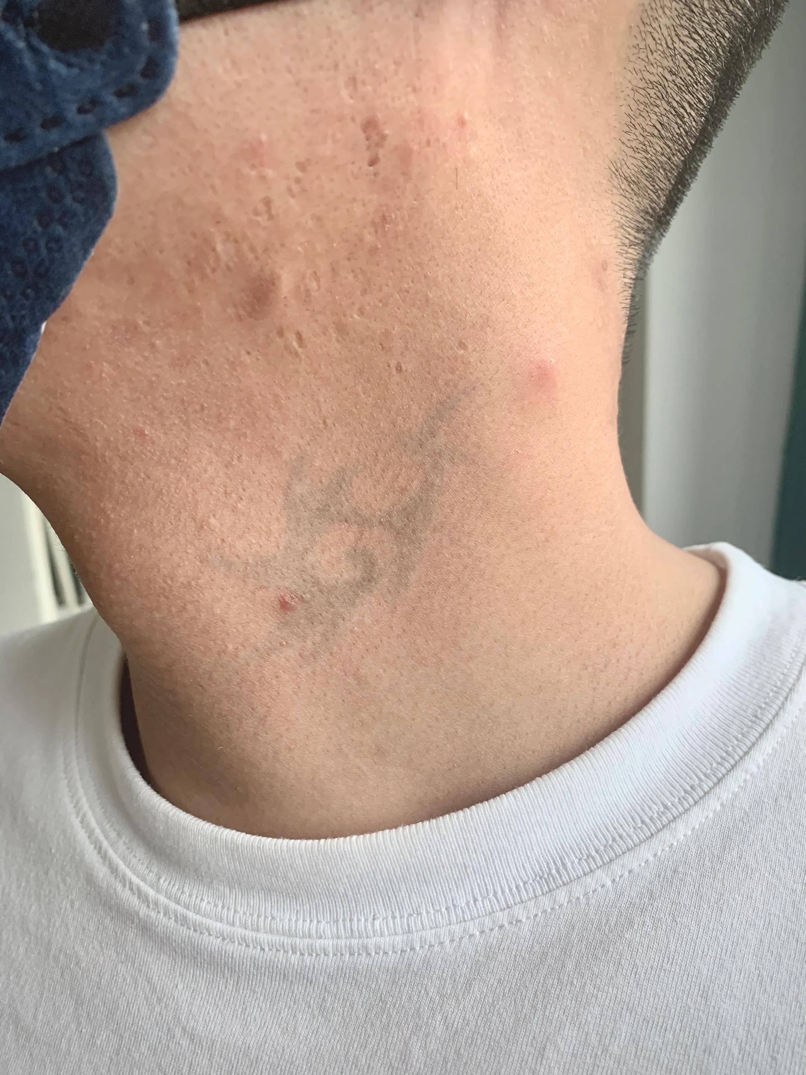 广州一次性洗纹身技术,深圳洗纹身不留疤哪家好