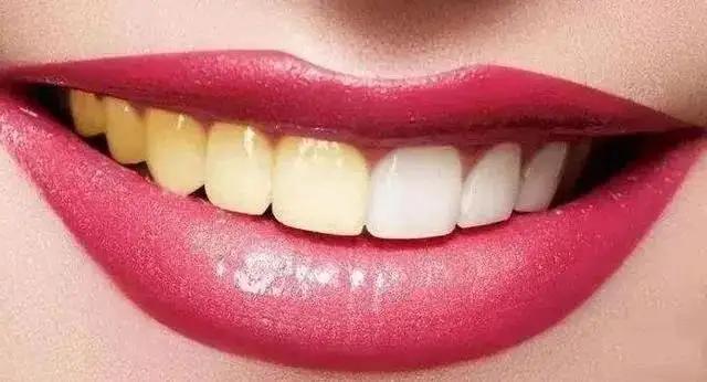 拜拜大黄牙，笑起来更甜