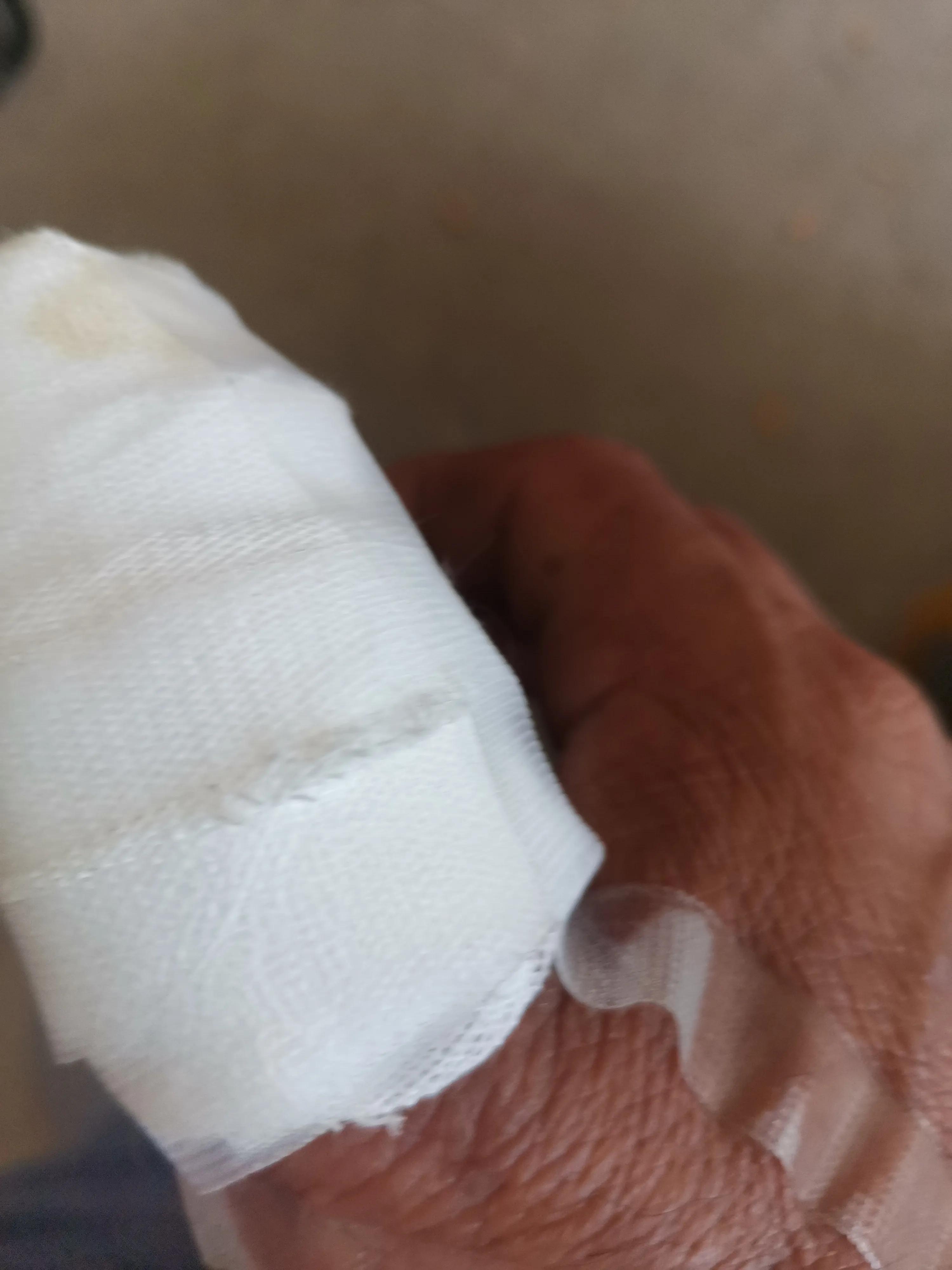 拇指化脓性感染护理问题,大拇指感染肿了消肿最快方法