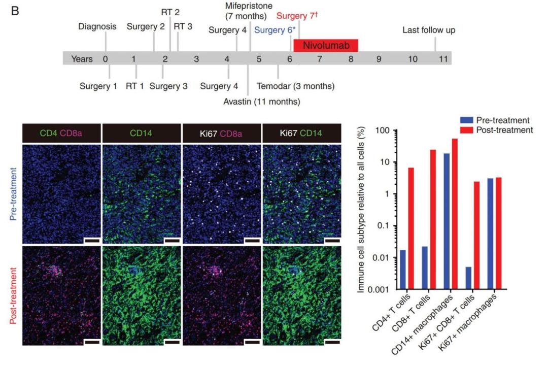 纳武单抗治疗肺癌效果,纳武利尤单抗治疗胃癌转移骨癌