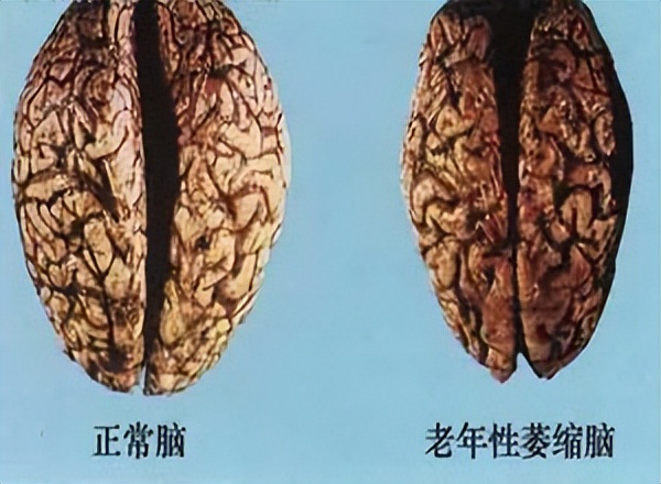 什么运动可以改善小脑萎缩,有没有什么偏方延缓小脑萎缩