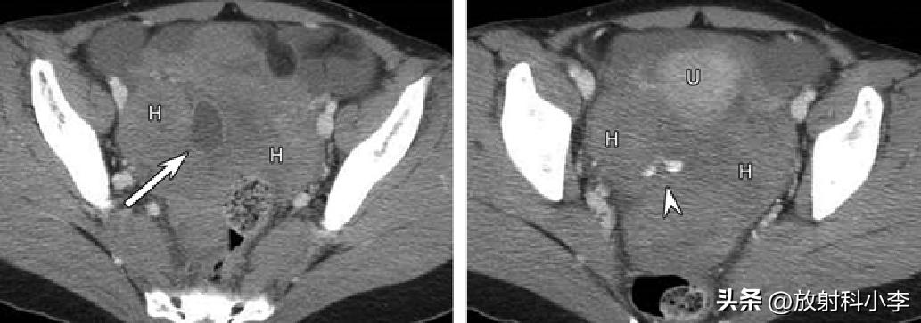 妇科急腹症的ct表现,妇科急腹症的诊断与治疗