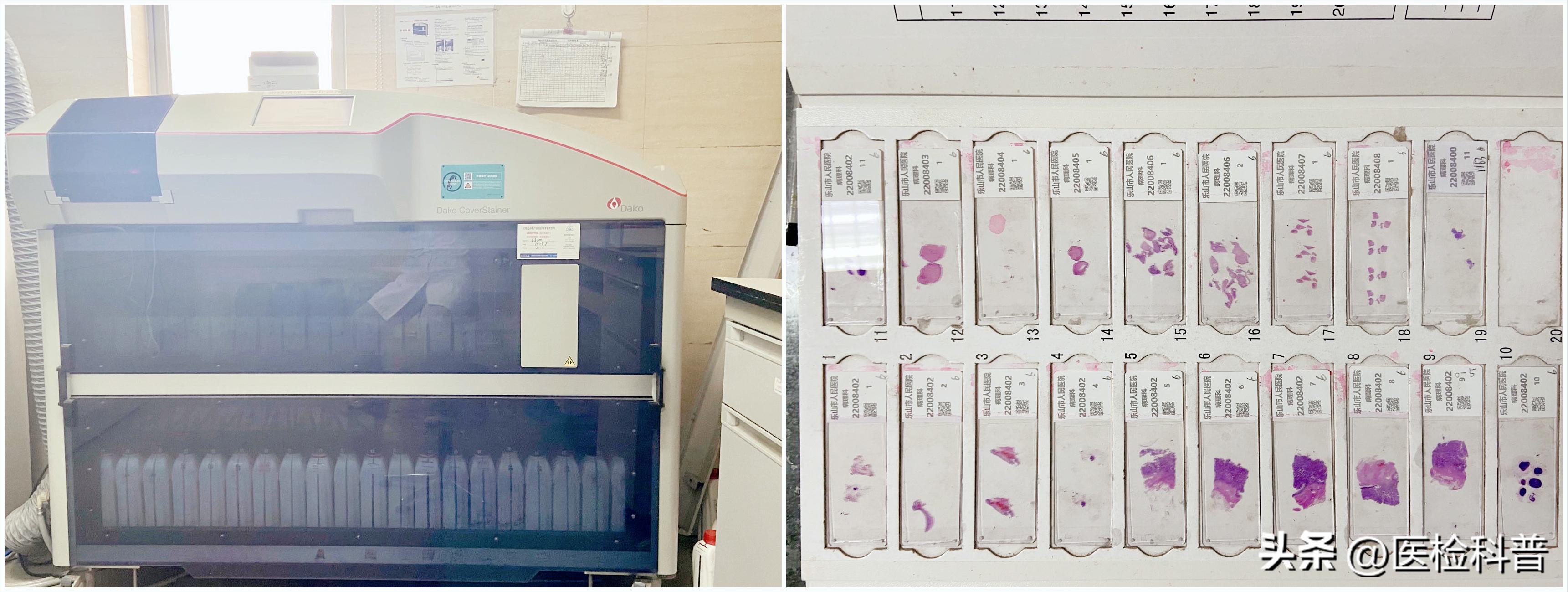 医院失误导致女子胸部被切除,女子被误诊切除子宫