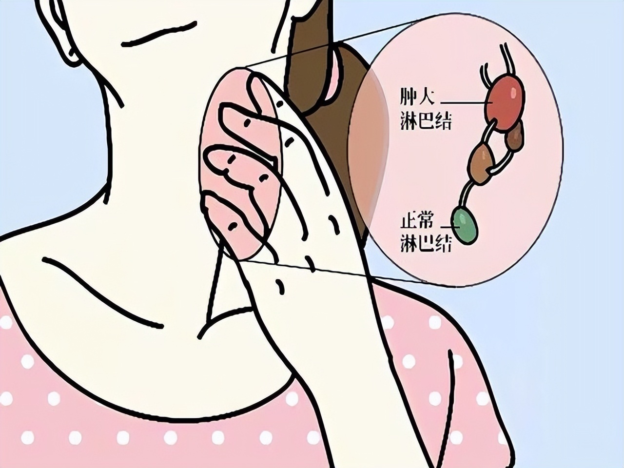 准妈妈痰中带血不在意,误把鼻咽癌症状当成孕吐所致