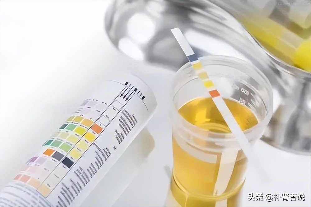 如何解读尿常规体检报告,体检尿常规一般都有什么项目