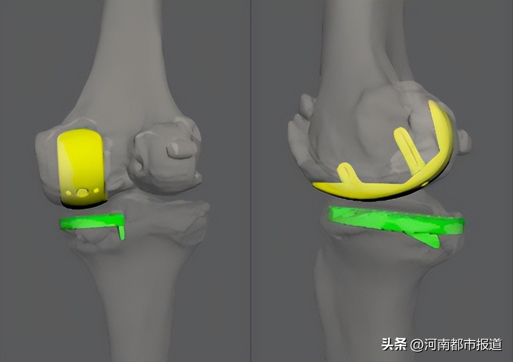 全球首例3d打印距骨表面假体置换,首例医生3d打印距骨表面植入人体