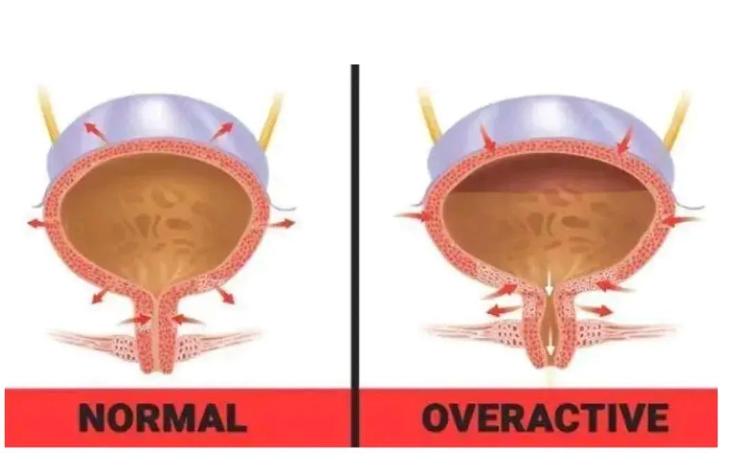 顽固性间质性膀胱炎,间歇性膀胱炎会终生尿频吗