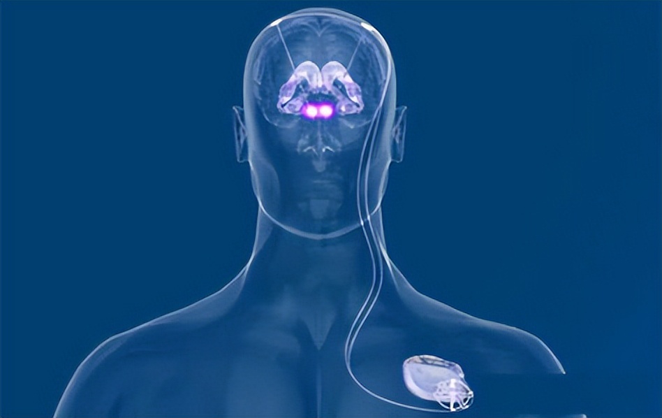 dbs治疗帕金森僵直,dbs帕金森原理