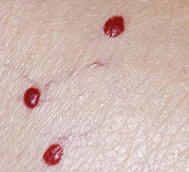 今年35岁发现皮肤长有小红痣,身上出现小红痣是不是皮肤老化了