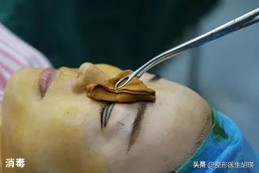 双眼皮术后20天基本不再变化了,挑战双眼皮术后39天做睫毛