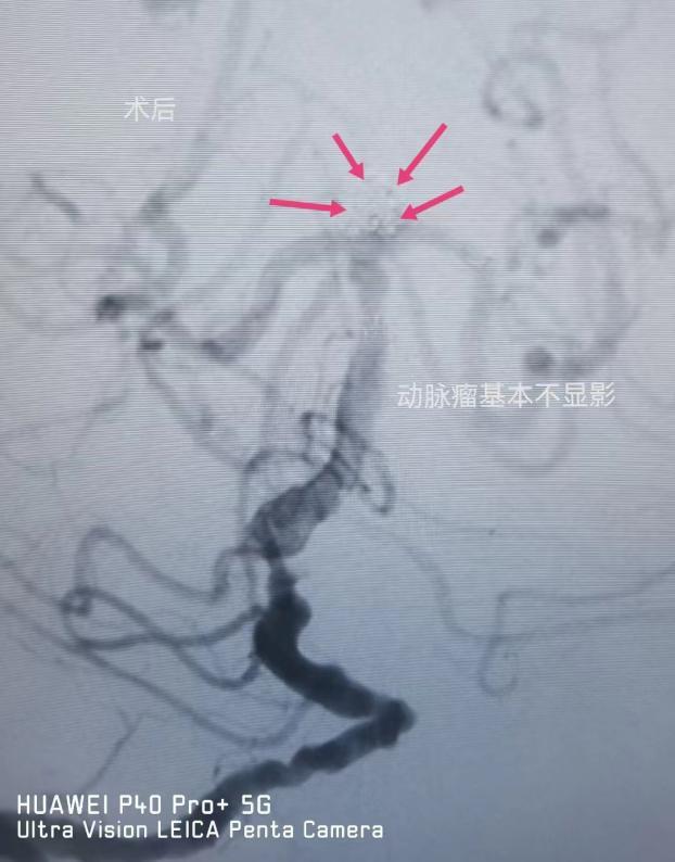 沣东院区脑病病区成功完成多例脑血管造影及颅内支架植入术