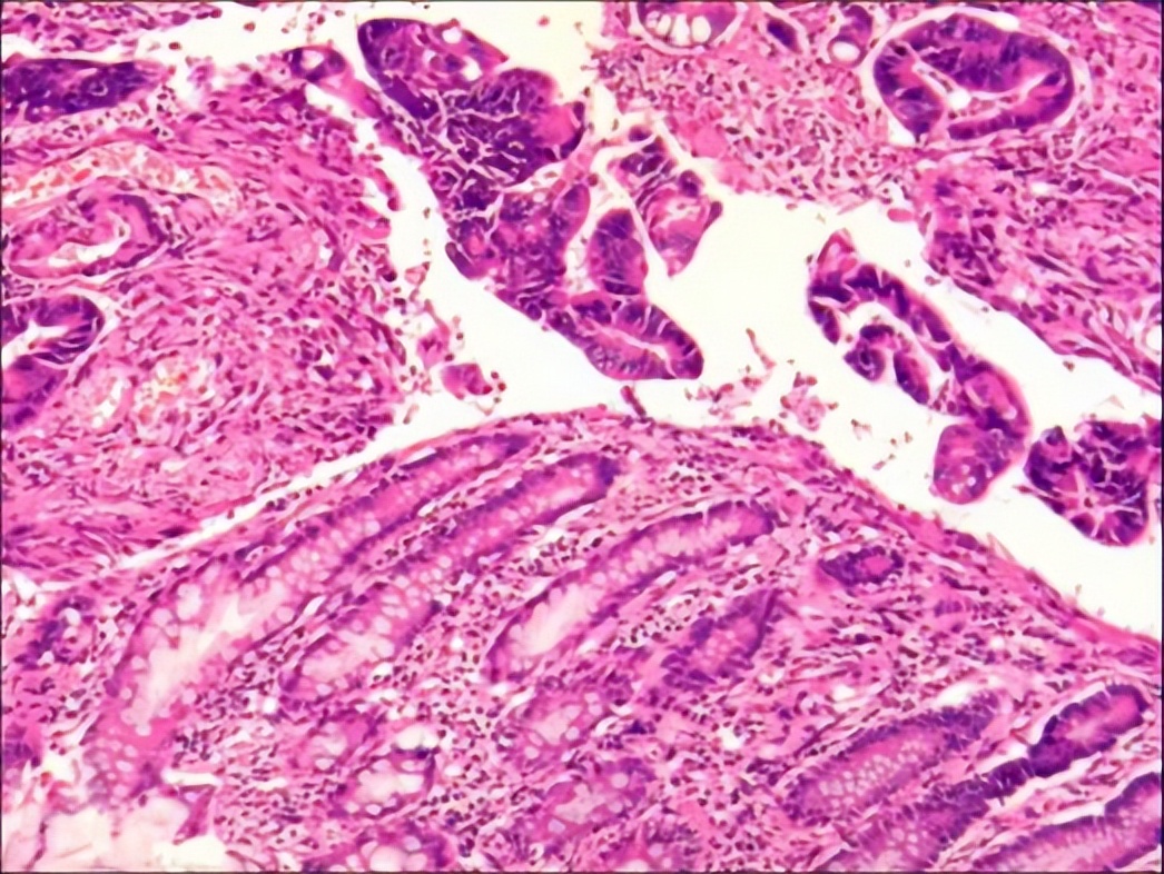 多原发癌症转移,多原发直肠癌