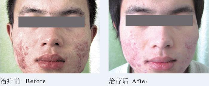 青春痘逆袭的方法,16岁青春期学生痘印如何改善