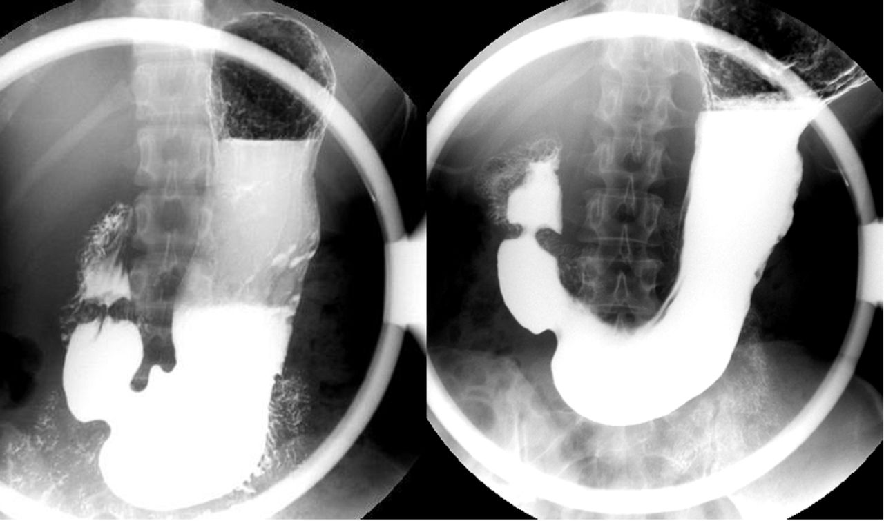 吃氯吡格雷便血怎么办,氢氯吡格雷片会导致便血吗