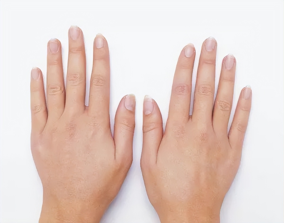 手脱皮如何判断是缺维生素还是癣,手脱皮是不痒是感染了癣吗