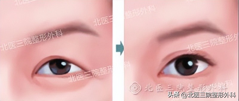 埋线双眼皮能解决皮肤松弛吗,单眼皮变成双眼皮是皮肤松弛了吗