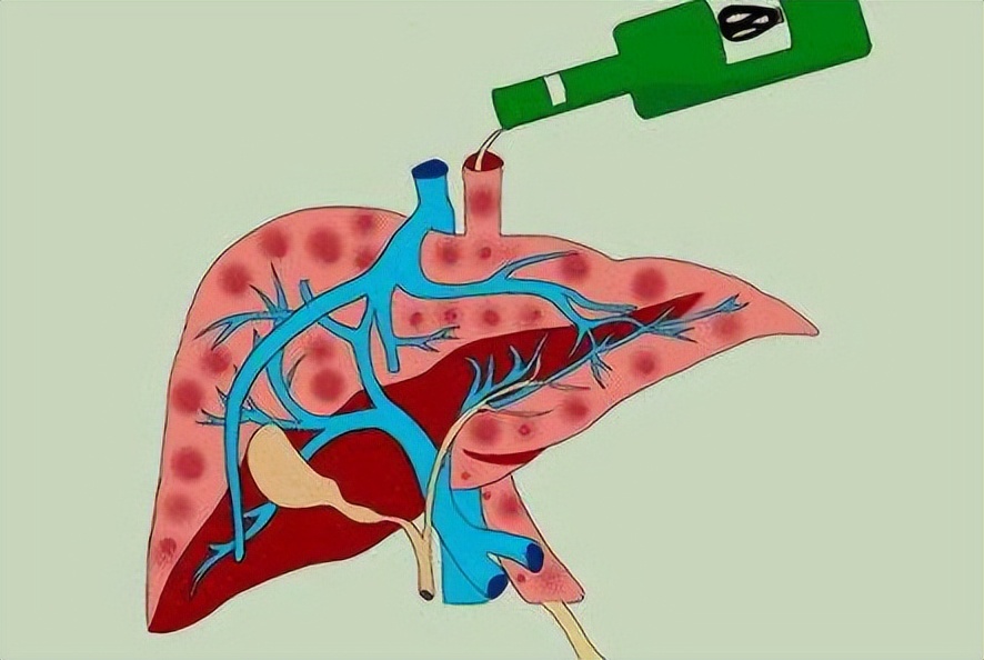 导致肝病的生活习惯有哪些,什么习惯会引发肝病