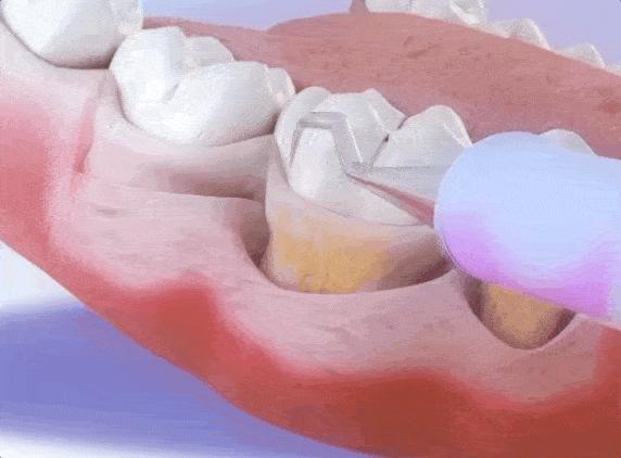 牙周炎犯了不治疗自己会自愈吗,得了牙周炎暂时不能去医院怎么办