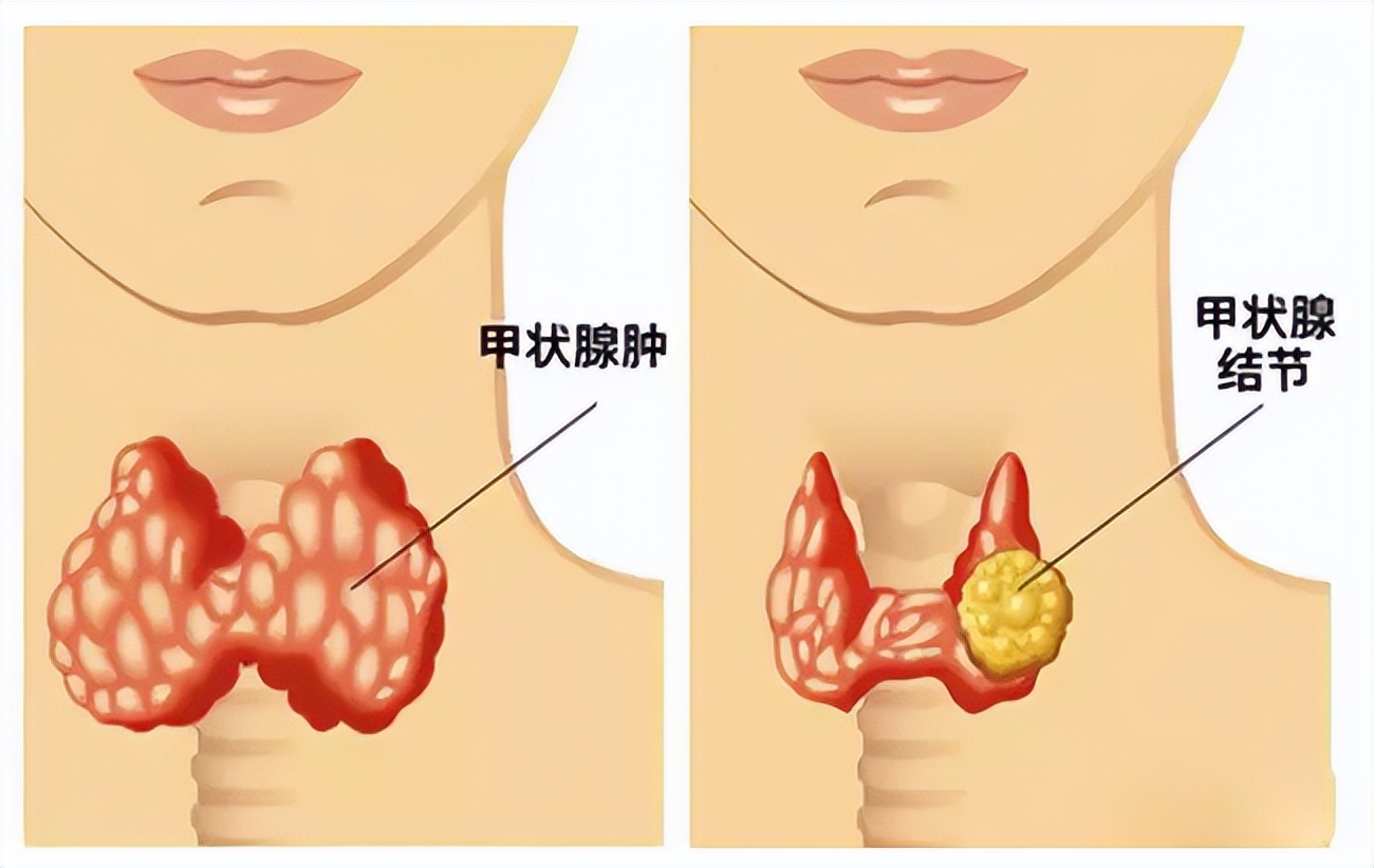 嗓子有痰怎么才能祛痰吃什么药,喉咙有痰吃什么祛痰药最快