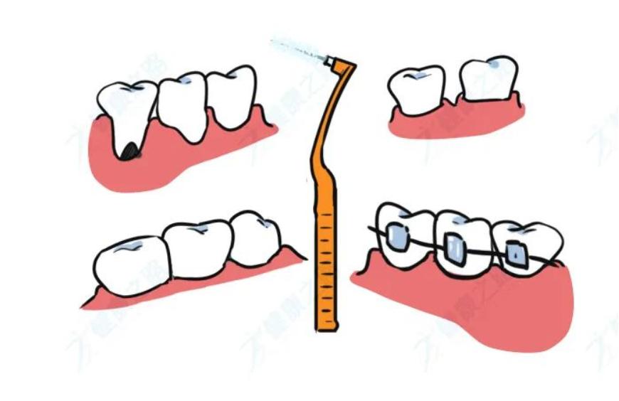 电动牙刷到底对牙齿好吗,电动牙刷真的比普通牙刷效果好吗