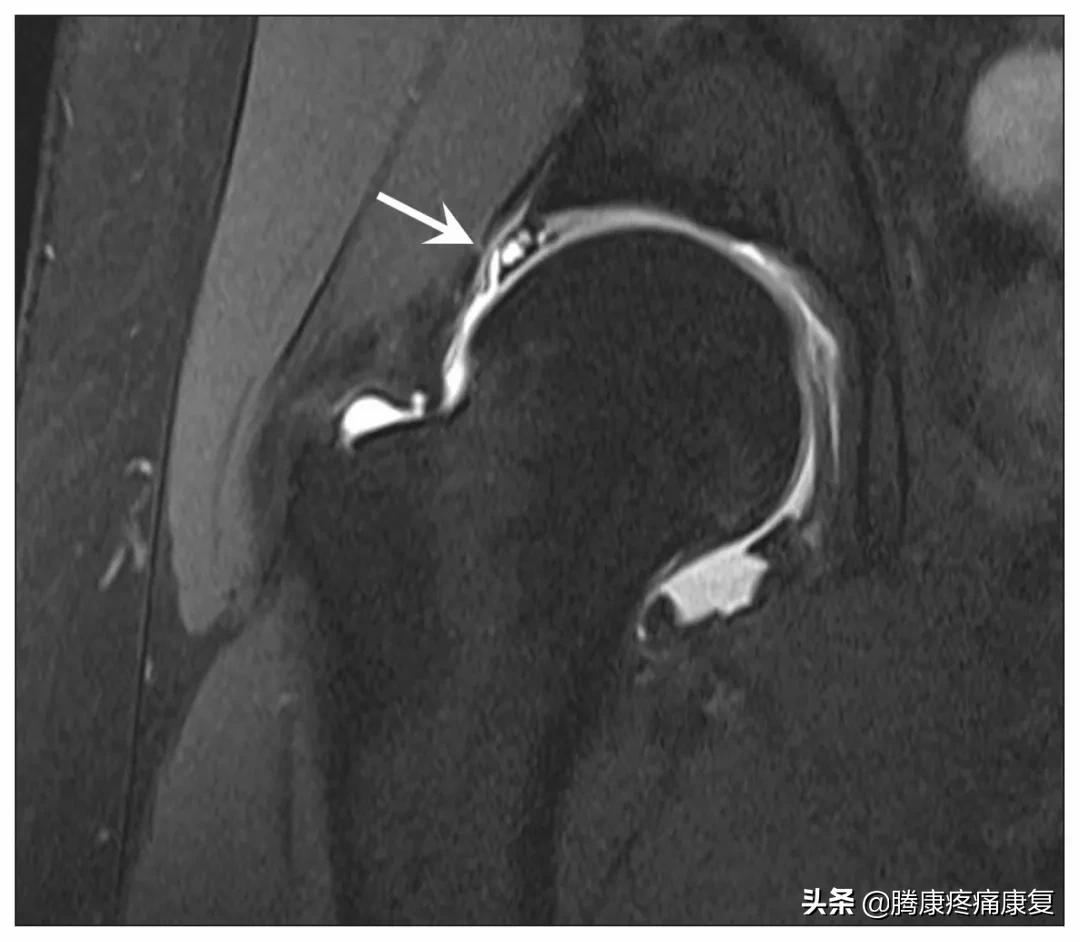 肩袖损伤有疼痛感但不影响干活,肩袖损伤疼痛不明显