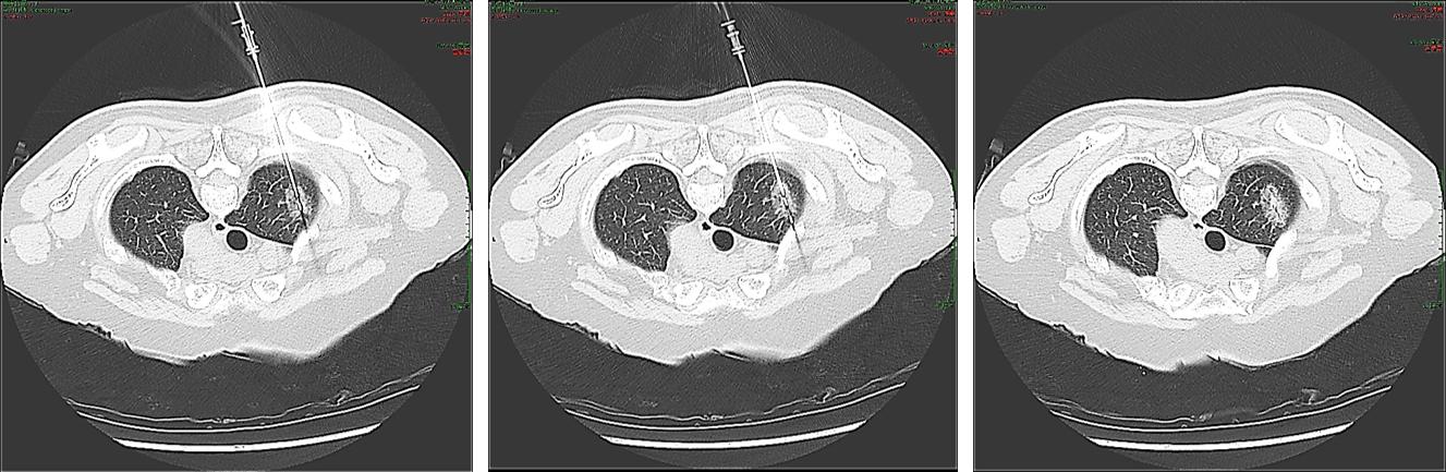 肺高危磨玻璃结节怎么治疗最好,肺磨玻璃结节影微创手术