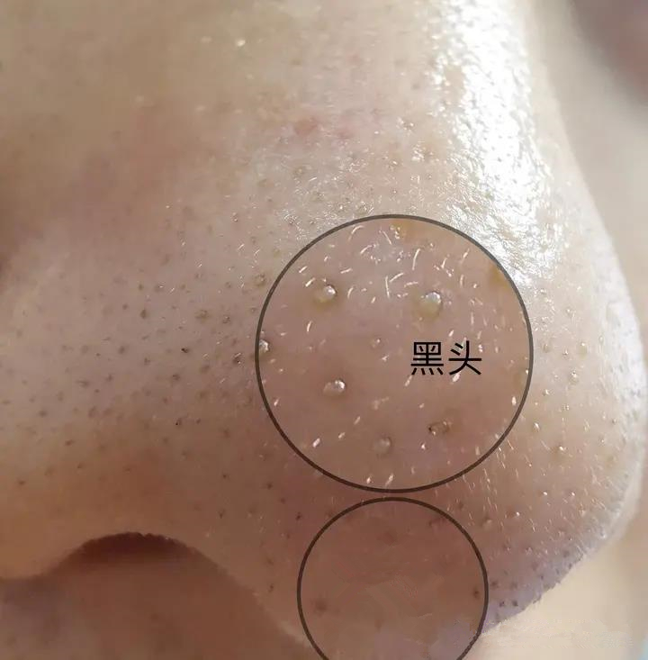 去除鼻子黑头收缩毛孔小妙招,鼻子黑头毛孔大抹什么药膏