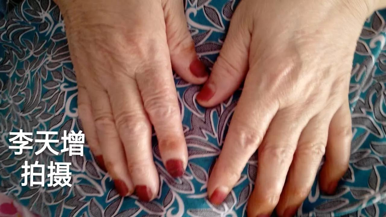 40岁女性手背开始很多皱纹怎么办,手背皮肤松弛皱纹多粗糙是啥原因