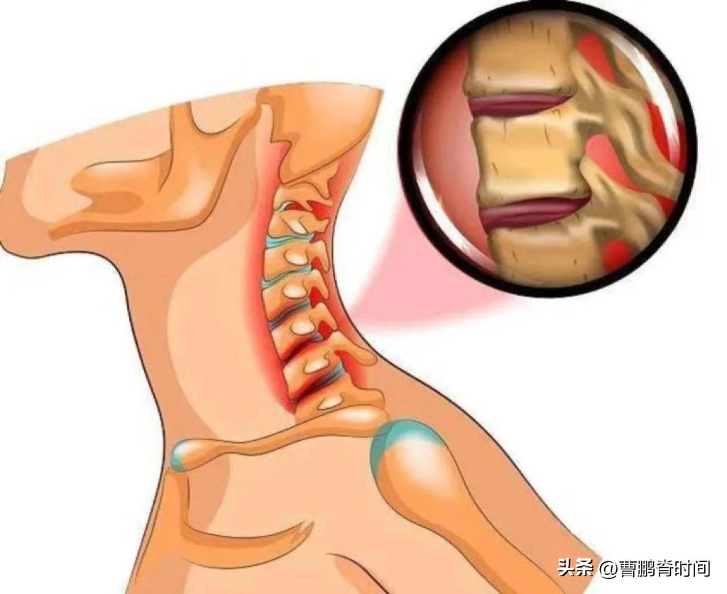 脖子两侧筋痛要警惕三种疾病,天生短脖子怎么改善