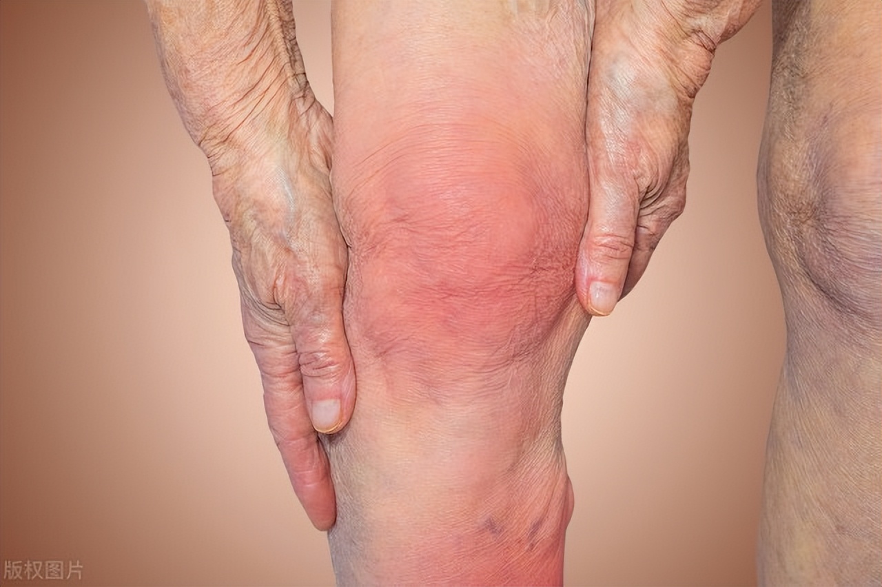 轻微的膝内翻怎么治,后天性膝内翻怎么治疗